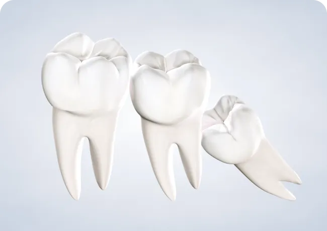 Home  wisdom teeth removal