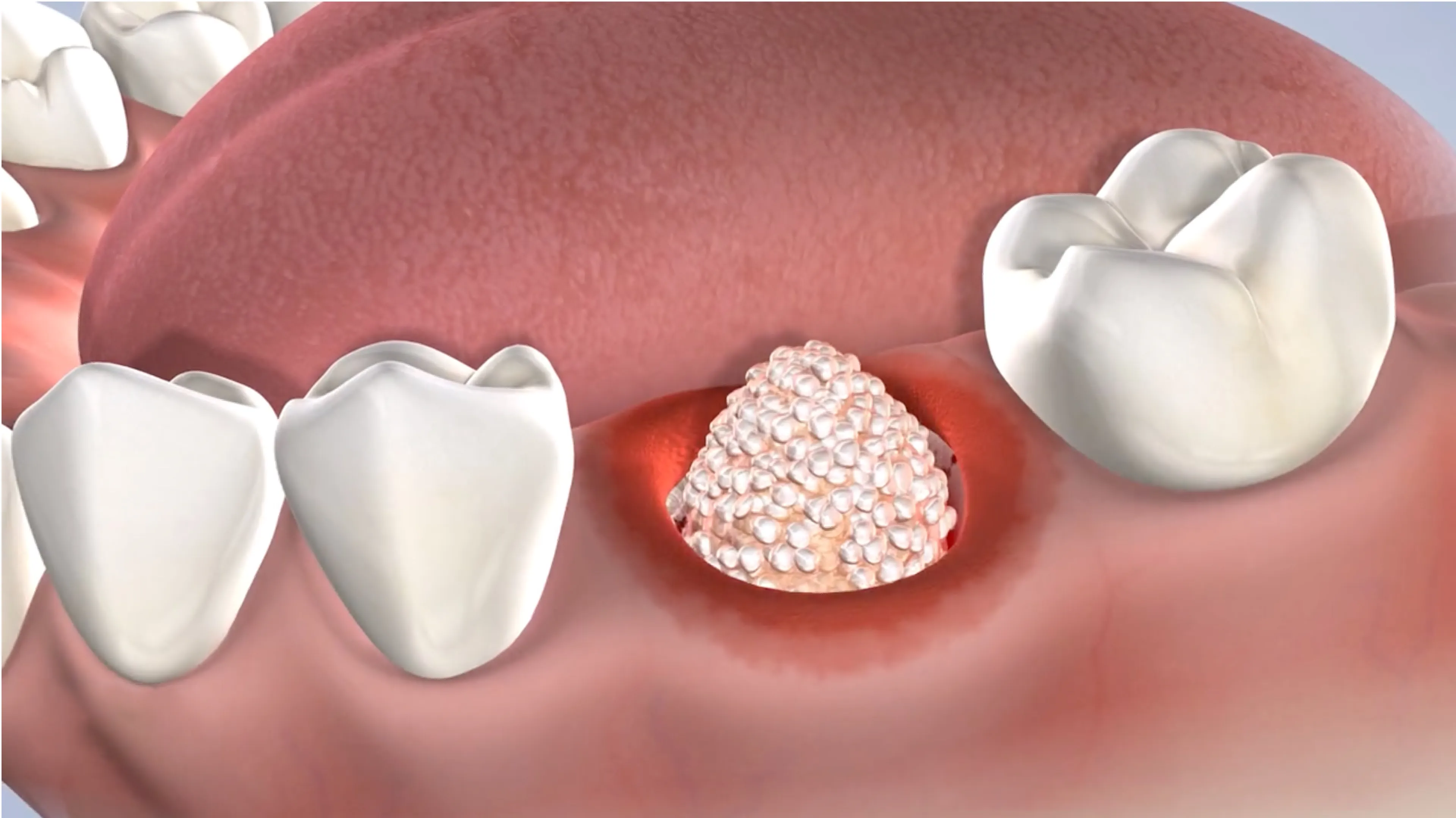 Instruction  bone grafting