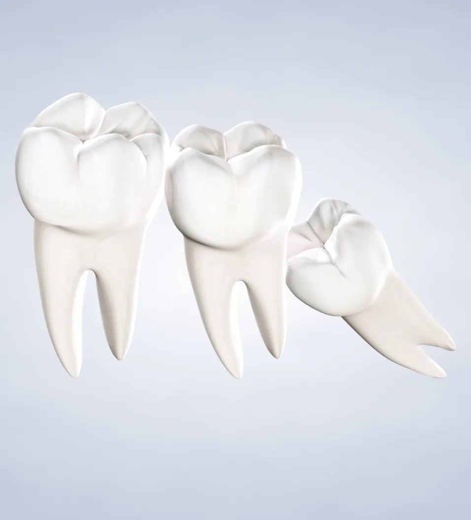 Query  wisdom teeth removal